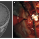 Illustration for article titled Surgeons shocked to find fully formed teeth in a babys brain tumor